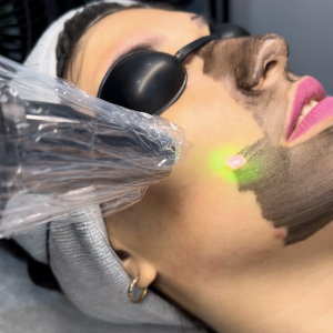 Tratamiento Hollywood Peel Facial