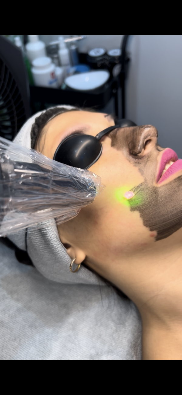 Tratamiento Hollywood Peel Facial