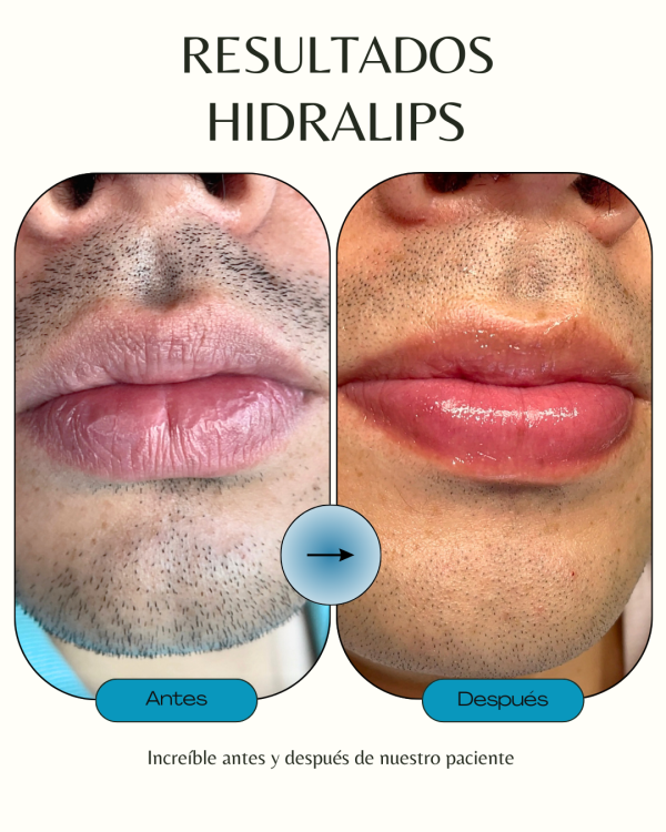 Hidralips